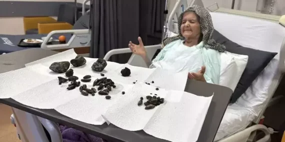 Ameliyat ile mideden çıkarıldılar