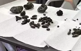 Ameliyat ile mideden çıkarıldılar