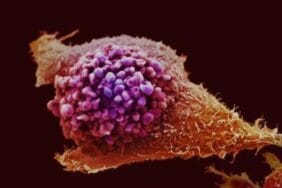 Prostat kanseri taramasında devrim: Yeni test alternatifi!