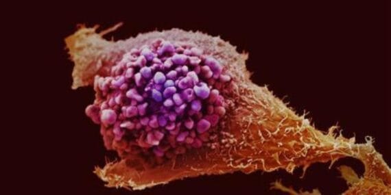 Prostat kanseri taramasında devrim: Yeni test alternatifi!